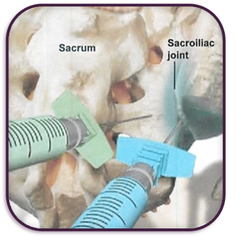 Si joint epidural steroid injection